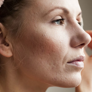 Experts Weigh in on Stress's Role in Premature Skin Aging